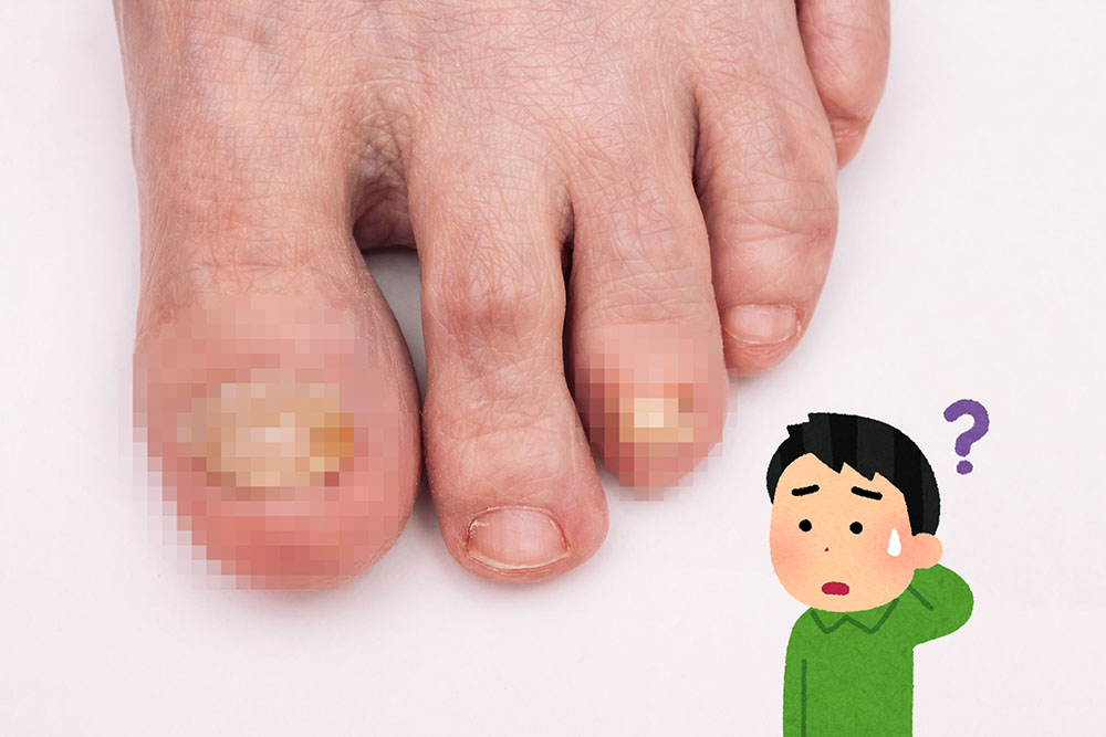 灰指甲不是灰色而是病！ 認識灰指甲的治療